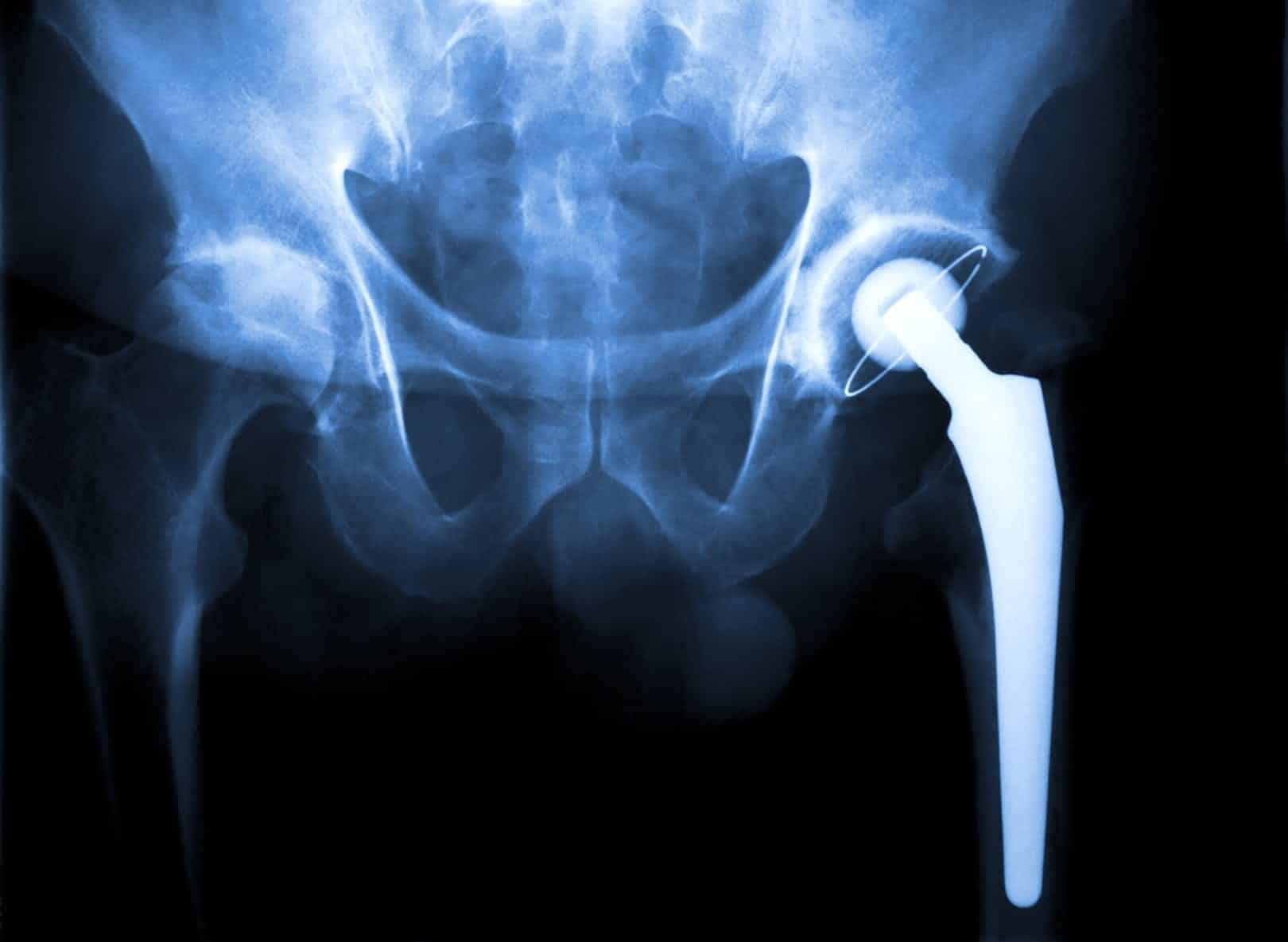 Wright Hip replacement - Goldwater Law Firm
